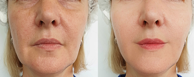 A Thread Lift May Be Right to Help You Reach Your Anti-Aging Goals