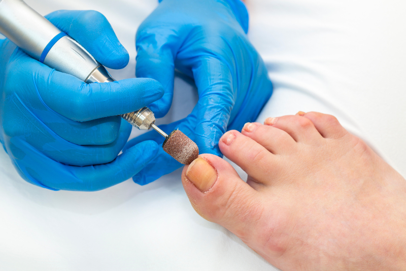 Why You Need to Consider Using Toenail Fungus Treatment In Jacksonville, FL