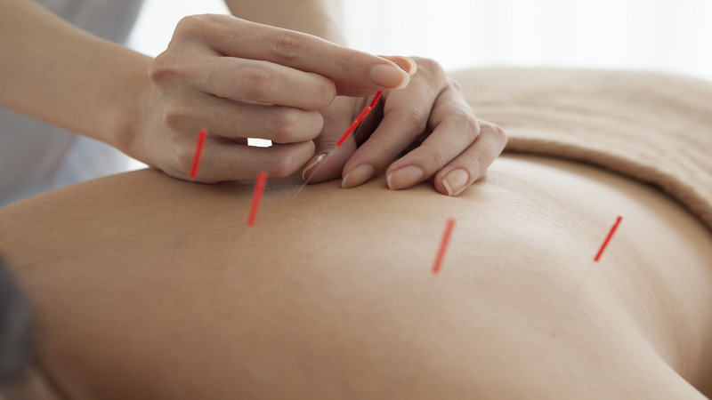 Pain Relief Solutions With a Local Acupuncturist Union City, CA Residents Trust