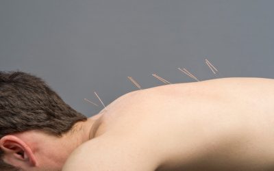 Improve Stress Management with Acupuncture at Sudden Valley WA Health Practices