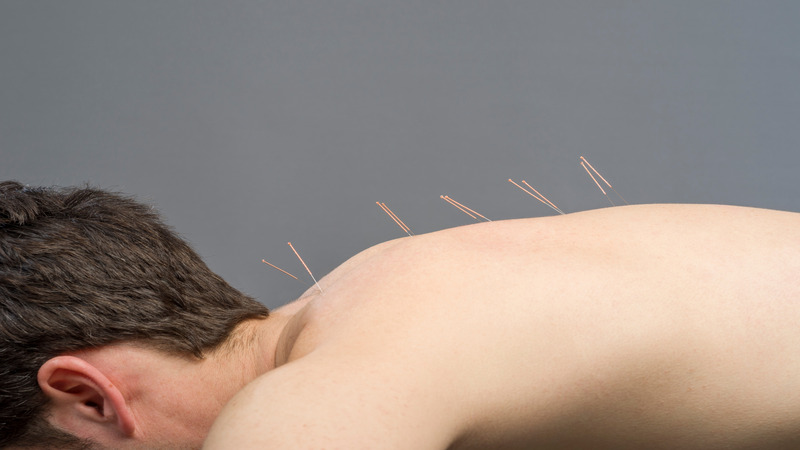 Improve Stress Management with Acupuncture at Sudden Valley WA Health Practices